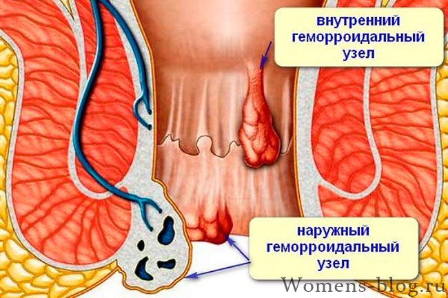 Геморрой